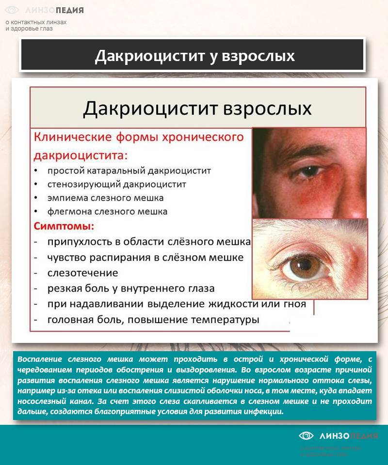 Синдром «сухого глаза»: причины возникновения и диагностика | лечение роговично-конъюнктивального ксероза