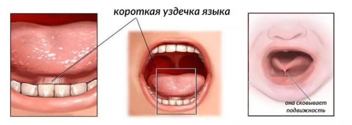 Подрезание уздечки языка: последствия, диагностика, способы подрезания, рекомендации