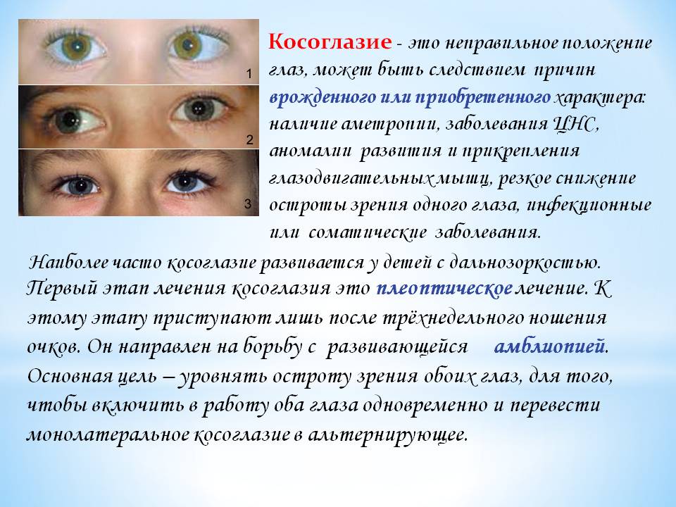 Косит глаз причины. Косоглазие причины. Косоглазие причины возникновения. Нарушение зрения косоглазие. Косоглазие у детей причины.