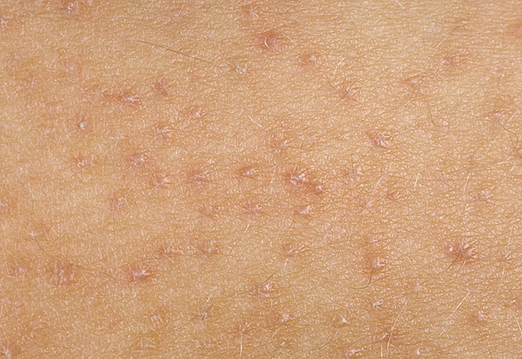 Высыпания на коже у детей – 35 распространённых заболеваний