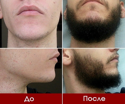 Как отрастить бороду подростку в 14, 15, 16, 17 лет: все способы | spacream.ru