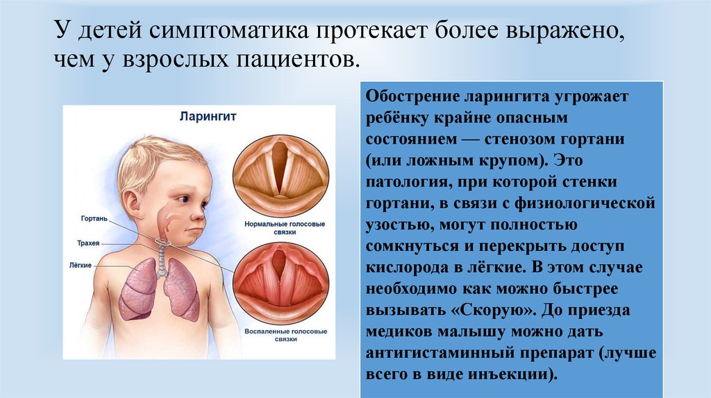 Ларингит острый и хронический. лечение ларингита. симптомы при ларингите.