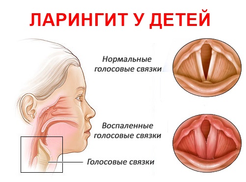 Хронический ларингит у детей - симптомы и лечение ларингита у ребенка