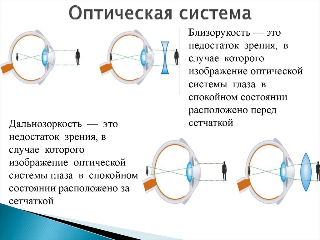Как можно скорректировать дальнозоркость. Оптическая система глаза при близорукости. Зрительная система дальнозоркость. Близорукость (истинная и ложная формы патологии). Оптическое строение глаза.