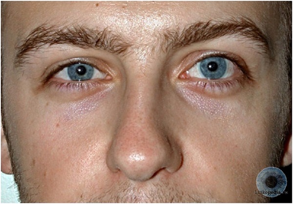 Почему увеличивается глаза. Асимметрия глазных яблок. Разные веки на глазах.