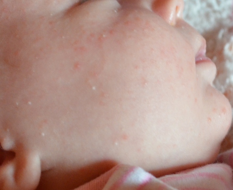 Что делать, если появились высыпания на коже младенца?