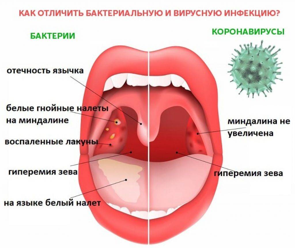 Сыпь температура боль в горле у ребенка. Бактериальная ангина зев.