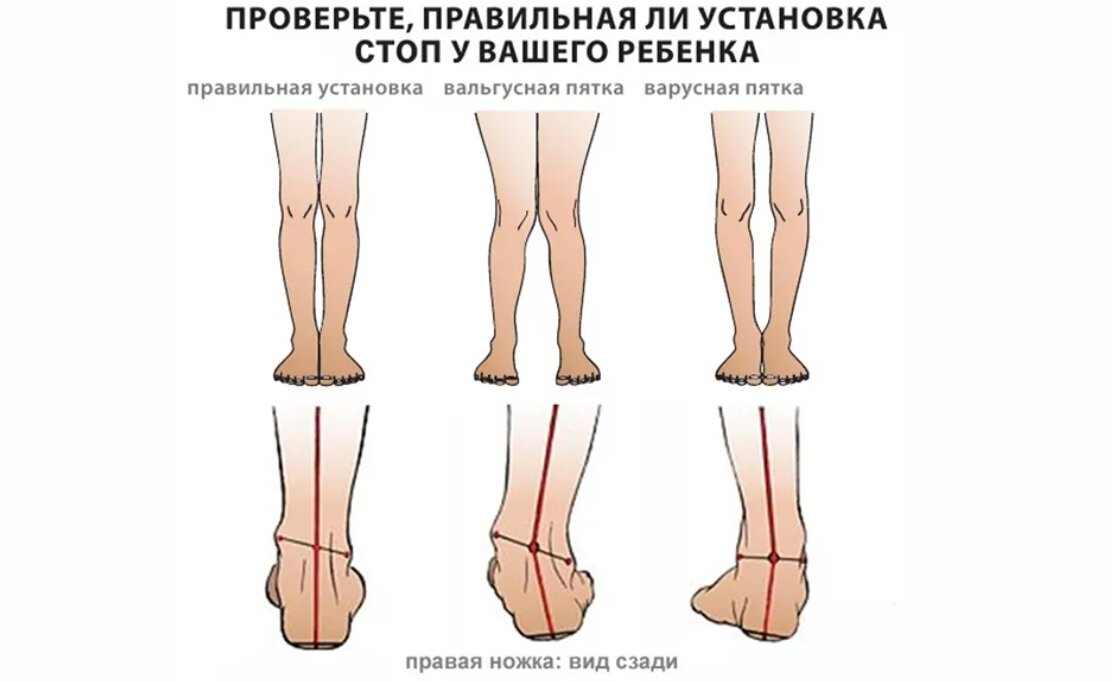 Одна нога другой короче и глаз. Вальгусная и варусная деформация стопы. Варусная деформация стопы рентген. Вальгусная деформация и варусная деформация. Плоско варусная деформация стопы.
