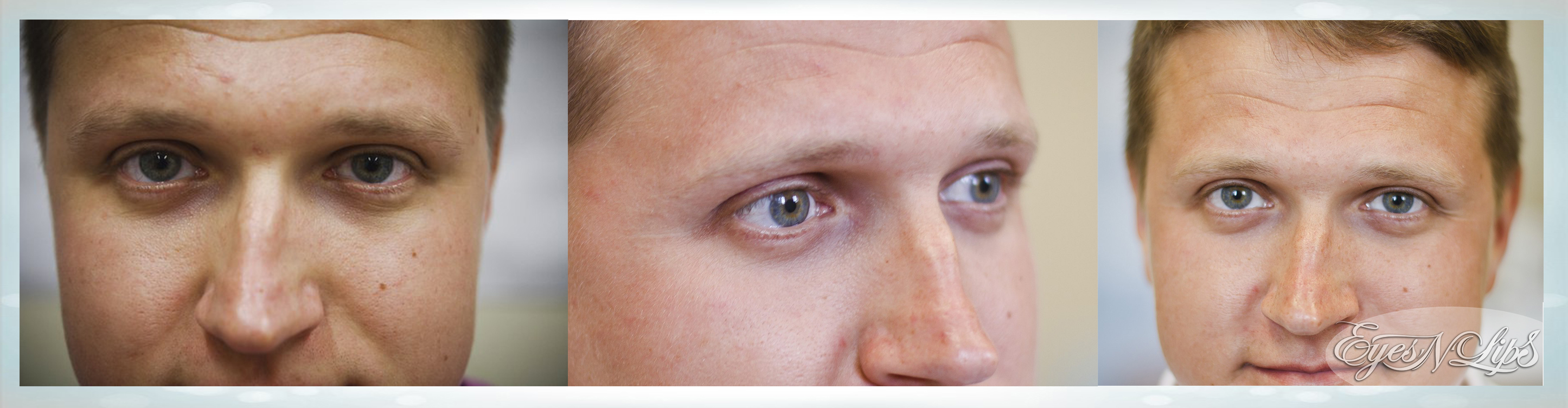 Мешки под глазами причина у мужчин лечение. Уколы под глаза от темных кругов. Операция от темных кругов. Синяки под глазами до и после.