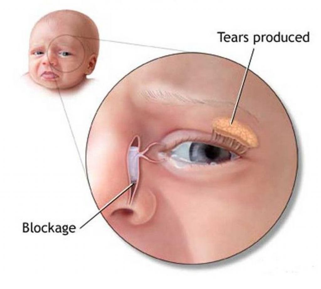 Промывание слезного канала у новорожденных и взрослых