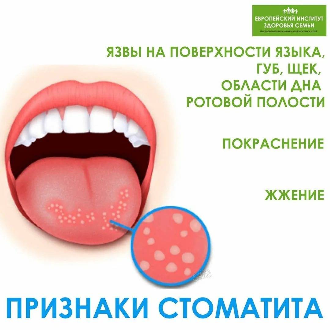 Белый налет на языке у грудничка: причины, диагностика и лечение